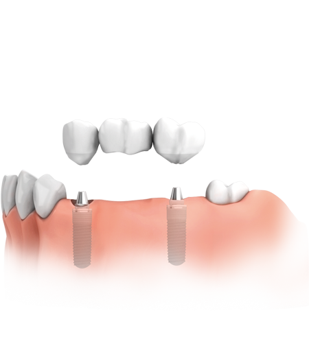 Mehrere Zähne fehlen : Die fehlenden Zähne werden durch Implantate ersetzt, auf die eine Brücke aufgesetzt wird. Nachbarzähne bleiben voll erhalten.