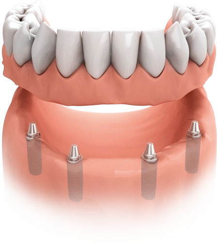 Sehr viele oder alle Zähne fehlen : Mit mehreren Implantaten haben Teil- oder Vollprothesen, herausnehmbar oder festsitzend, einen festen Halt.