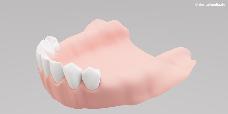 Kiefer mit bestehenden natürlichen Zähnen