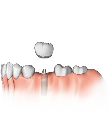 Ein Zahn fehlt: Das Implantat hat gegenüber einer Brücke den Vorteil, dass Nachbarzähne nicht beschliffen werden müssen.