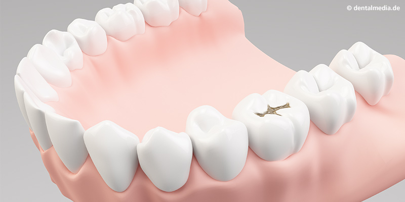Durch Karies geschädigter Zahn