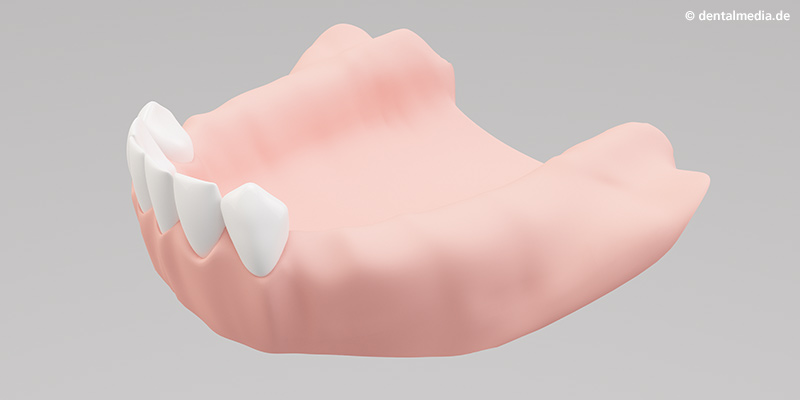 Kiefer mit bestehenden natürlichen Zähnen