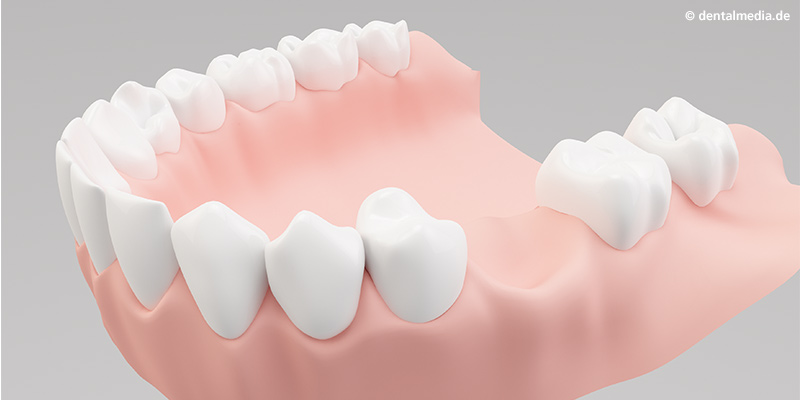 Kiefer mit der zu versorgenden Zahnlücke Kiefer mit der zu versorgenden Zahnlücke