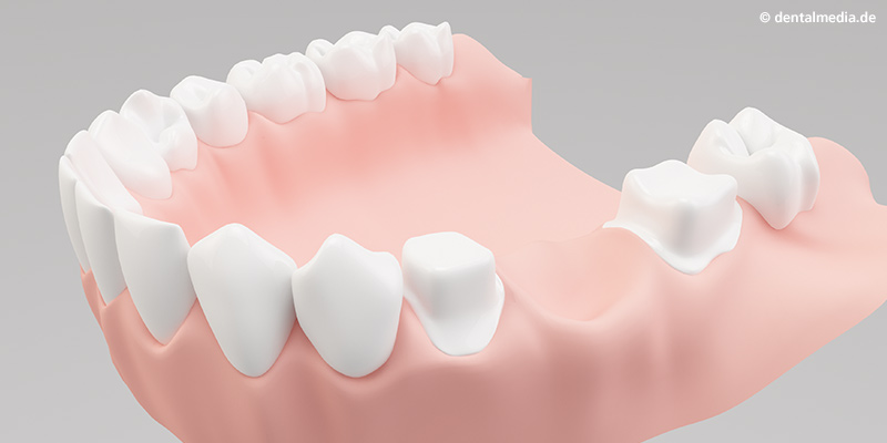 Benachbarte, beschliffene Zähne Benachbarte, beschliffene Zähne