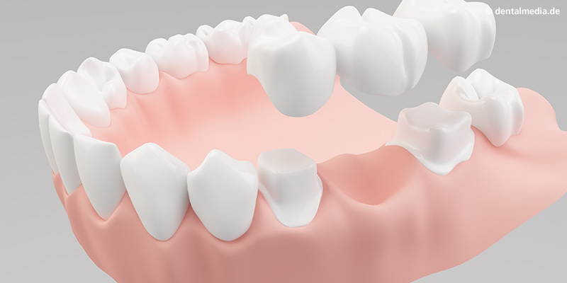 Befestigung der Brücke mithilfe eines speziellen Zahnklebstoffes Befestigung der Brücke mithilfe eines speziellen Zahnklebstoffes