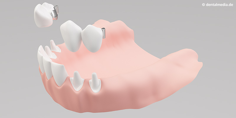 Befestigung des festsitzenden Kronenblocks mit Nut Befestigung des festsitzenden Kronenblocks mit Nut