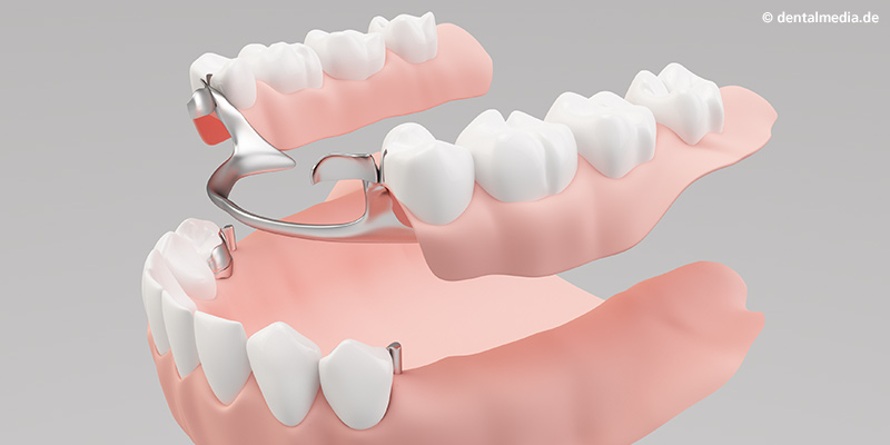 Aufsetzen der herausnehmbaren Prothese mit passendem Schlitz Aufsetzen der herausnehmbaren Prothese mit passendem Schlitz