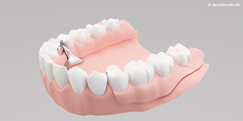 Ästhetisch anspruchsvolles Endergebnis Ästhetisch anspruchsvolles Endergebnis