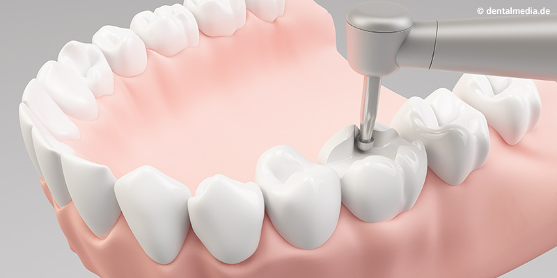 Entfernung der Karies. Präparieren des Zahnes Entfernung der Karies. Präparieren des Zahnes