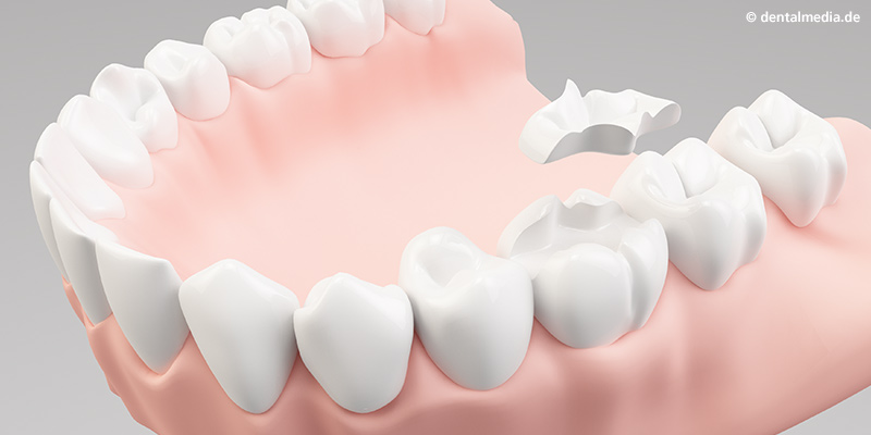 Einfügen des fertiggestellten Inlays mithilfe von einer Spezialklebetechnik Einfügen des fertiggestellten Inlays mithilfe von einer Spezialklebetechnik