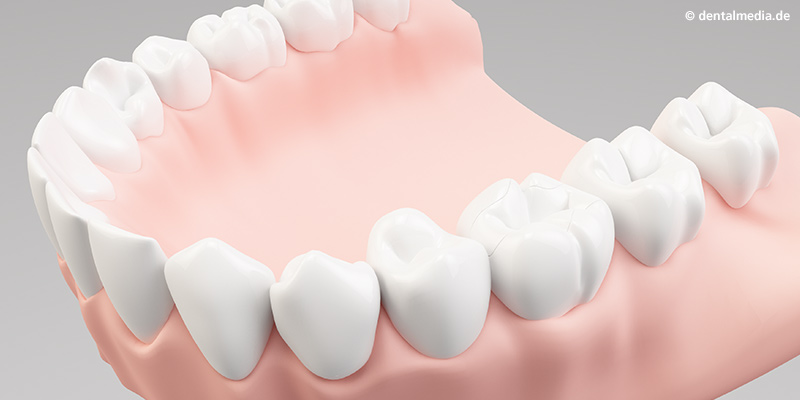 Eingesetztes Inlay Eingesetztes Inlay