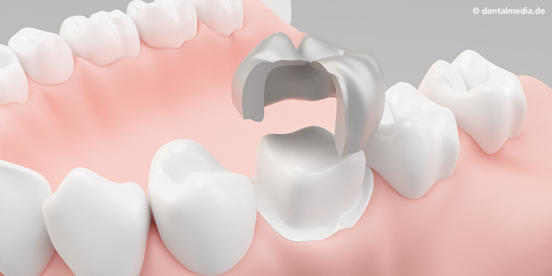 Vollgusskrone in Gold, Titan oder Stahl Vollgusskrone in Gold, Titan oder Stahl