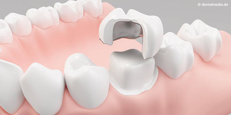 Verblendkrone mit Keramik oder Kunststoff verblendetem Metall Verblendkrone mit Keramik oder Kunststoff verblendetem Metall