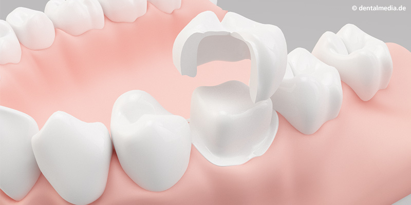 Metallfreie Krone - komplett bestehend aus Hochleistungskeramik Metallfreie Krone - komplett bestehend aus Hochleistungskeramik