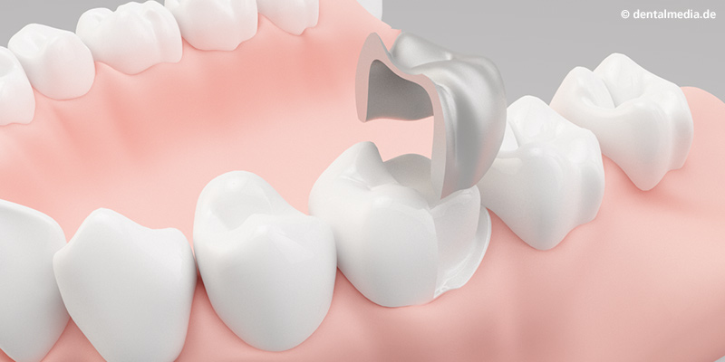 Teilkrone komplett bestehend aus Metall oder Keramik Teilkrone komplett bestehend aus Metall oder Keramik