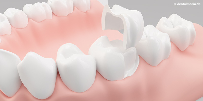 Teilkrone komplett bestehend aus Metall oder Keramik Teilkrone komplett bestehend aus Metall oder Keramik