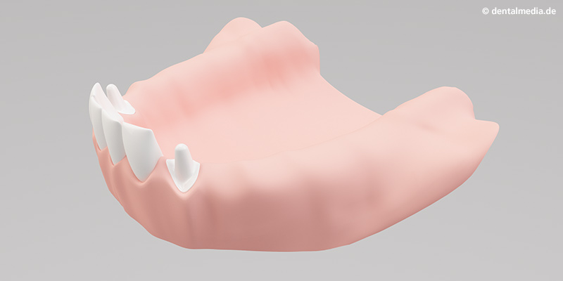 Beschleifen der beiden äußeren Zähne Beschleifen der beiden äußeren Zähne