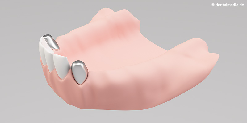 Aufstecken der Primärkronen auf die zuvor beschliffenen Zähne Aufstecken der Primärkronen auf die zuvor beschliffenen Zähne