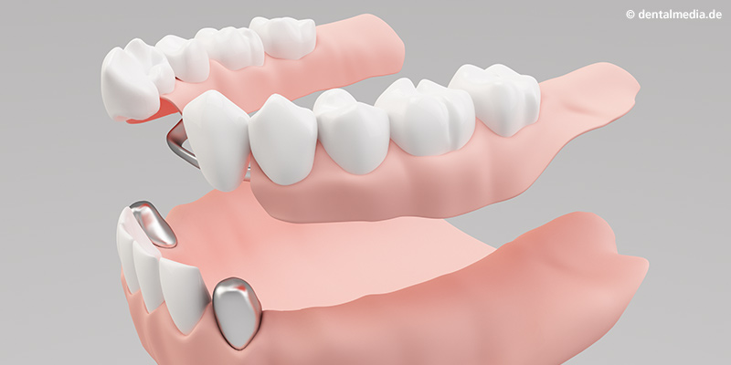 Aufstecken der Sekundärkrone auf die Primärkronen Aufstecken der Sekundärkrone auf die Primärkronen