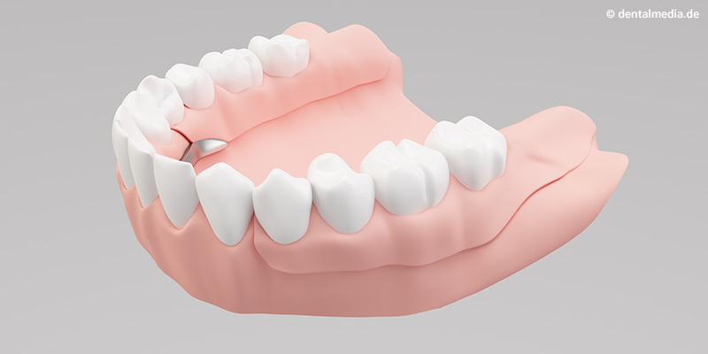 Ästhetisch anspruchsvolles Endergebnis Ästhetisch anspruchsvolles Endergebnis