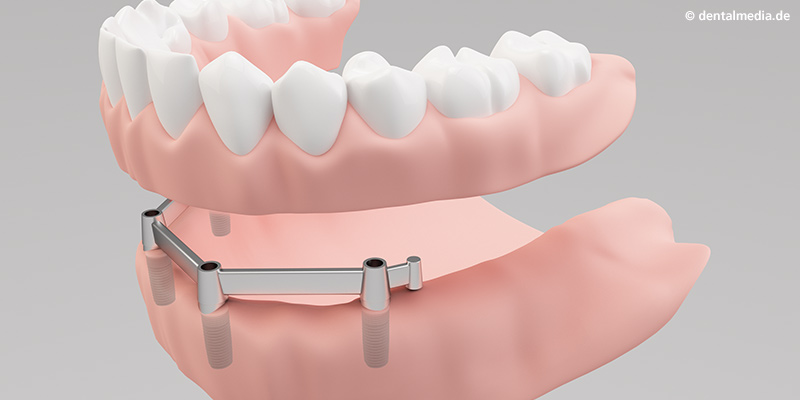 Aufsetzen der herausnehmbaren Vollprothese Aufsetzen der herausnehmbaren Vollprothese