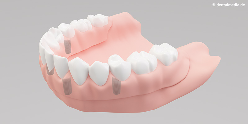 Ästhetisch anspruchsvolles Endergebnis mit herausnehmbarer Vollprothese Ästhetisch anspruchsvolles Endergebnis mit herausnehmbarer Vollprothese