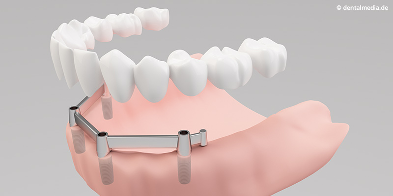 Aufsetzen der festsitzenden Vollprothese Aufsetzen der festsitzenden Vollprothese
