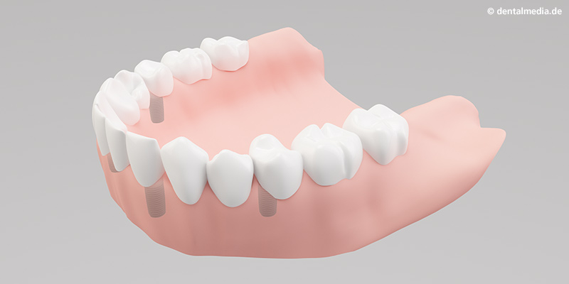 Ästhetisch anspruchsvolles Endergebnis mit festsitzenden Vollprothese Ästhetisch anspruchsvolles Endergebnis mit festsitzenden Vollprothese